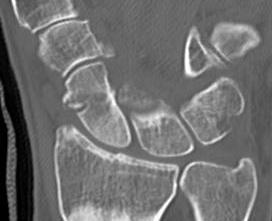 Incomplete Scaphoid Fracture